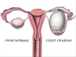 simptome chisturi ovariane, cauze chisturi ovariane